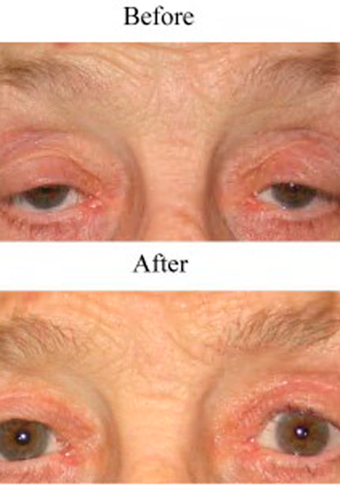 before-and-after-blepharoplasy2