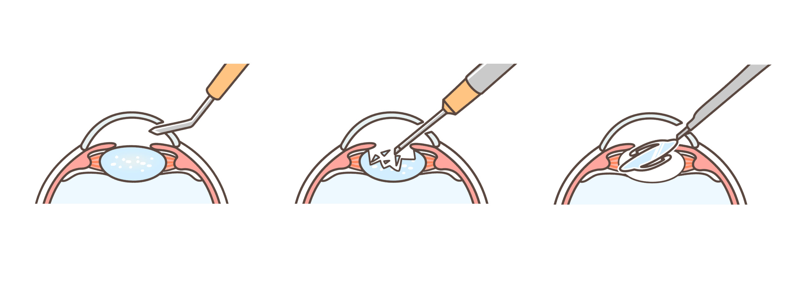 Step of cataract removal