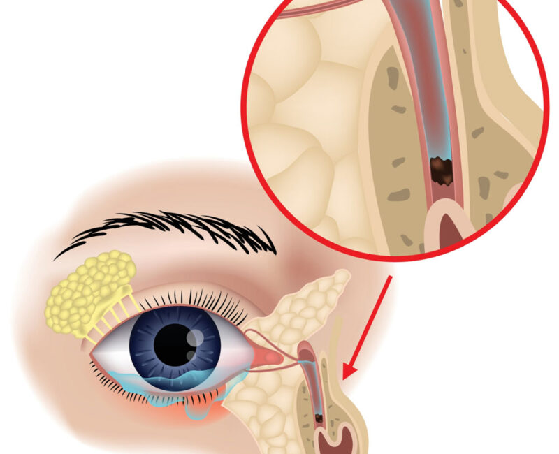 Dr. Affleck treats blocked tear ducts of all ages