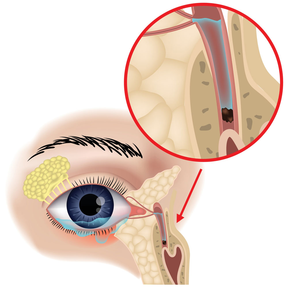 Dr. Affleck treats blocked tear ducts of all ages