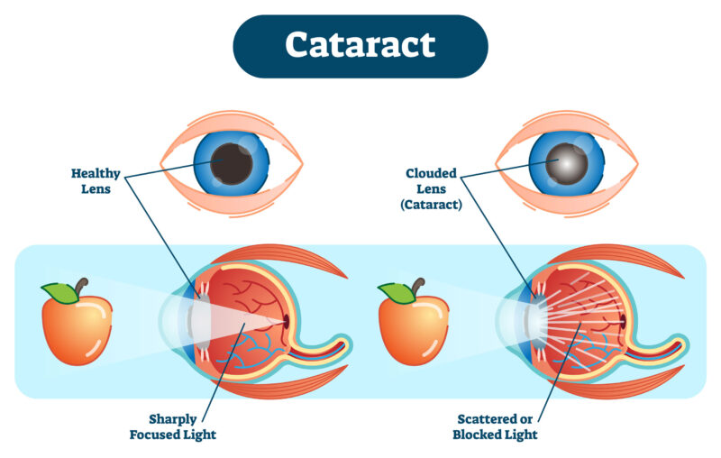 Cataract illustration