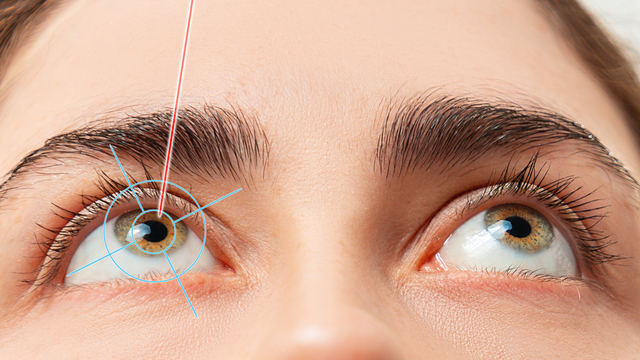 Laser Refractive Surgery